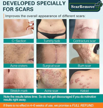 ScarRemove™ Advanced Narbenspray für Aknenarben. Operationsnarben und Dehnungsstreifen